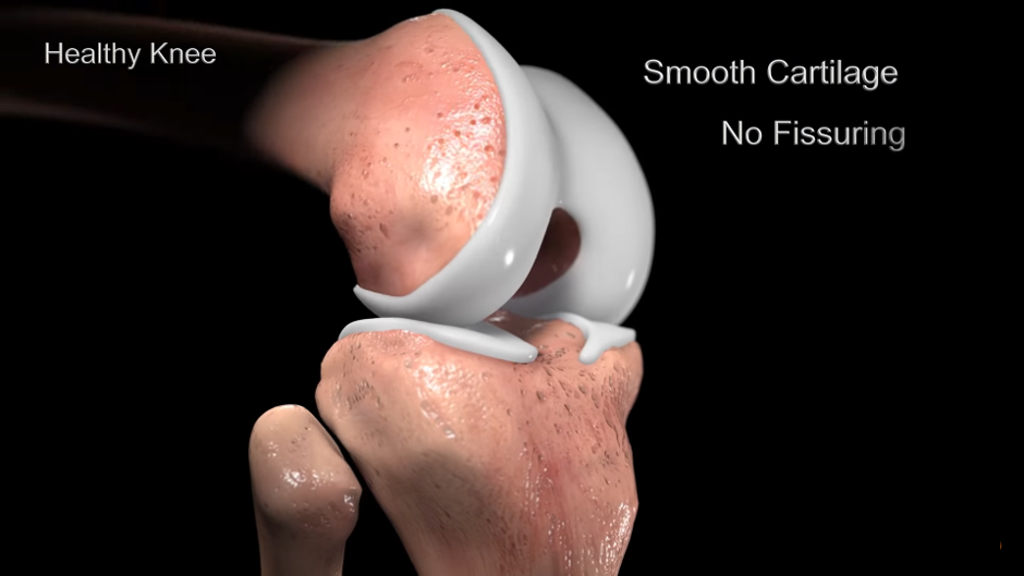 Tại sao sụn khớp bị bào mòn, nứt vỡ?