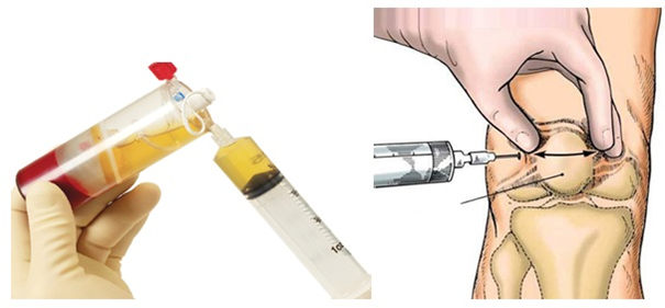 Tại sao sụn khớp bị bào mòn, nứt vỡ?