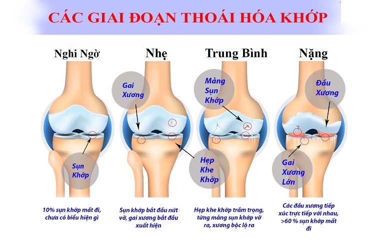 các giai đoạn của thoái hoá khớp gối