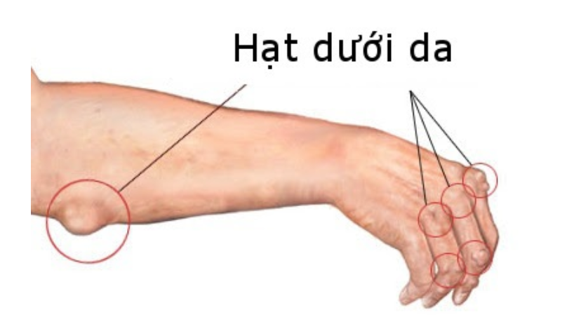 viêm khớp dạng thấp