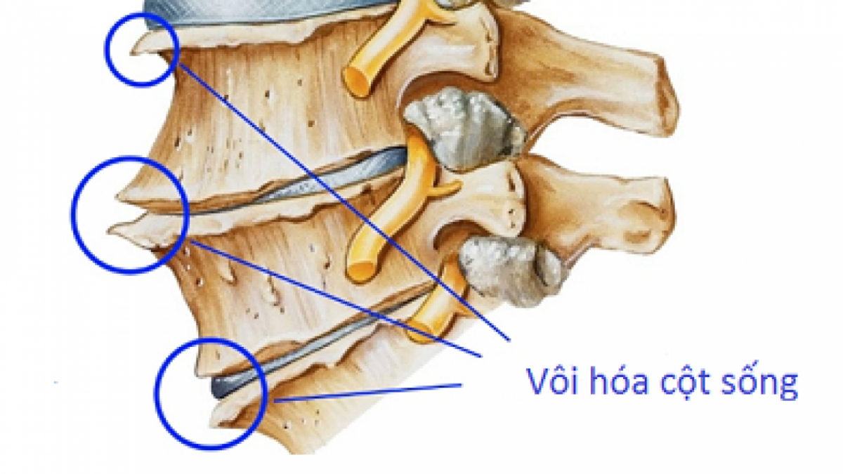 Nguyên nhân và cách chữa vôi hóa cột sống