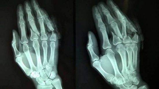 điều trị đau khớp ngón tay do gãy xương