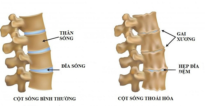 thoái hoá cột sống